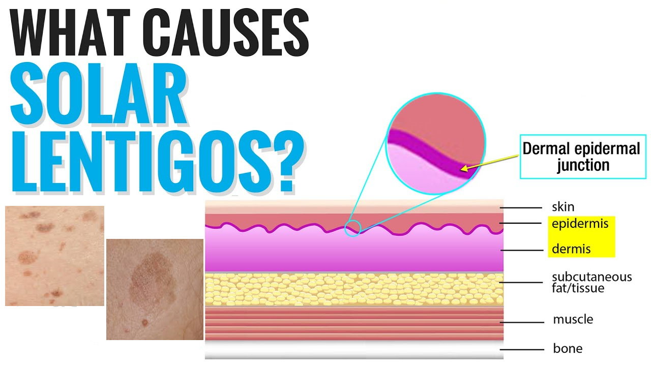 孚美达“氟轻松氢醌维A酸乳膏”能用于老年斑治疗吗？