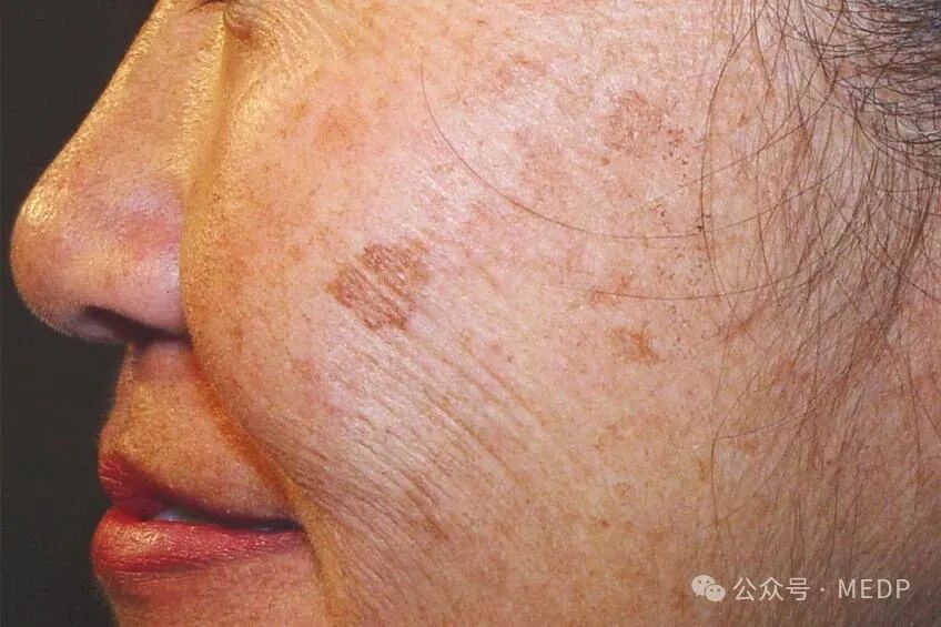 老年斑、晒斑、日光性雀斑是一回事吗？